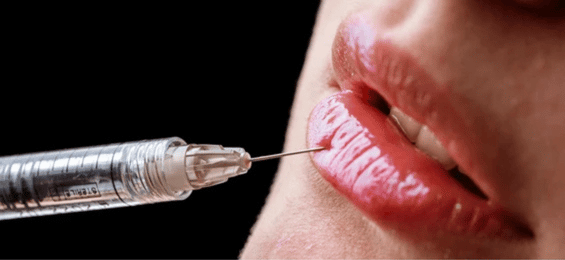 Lip Fillers treatment at Limitless Aesthetics in Gulberg Lahore