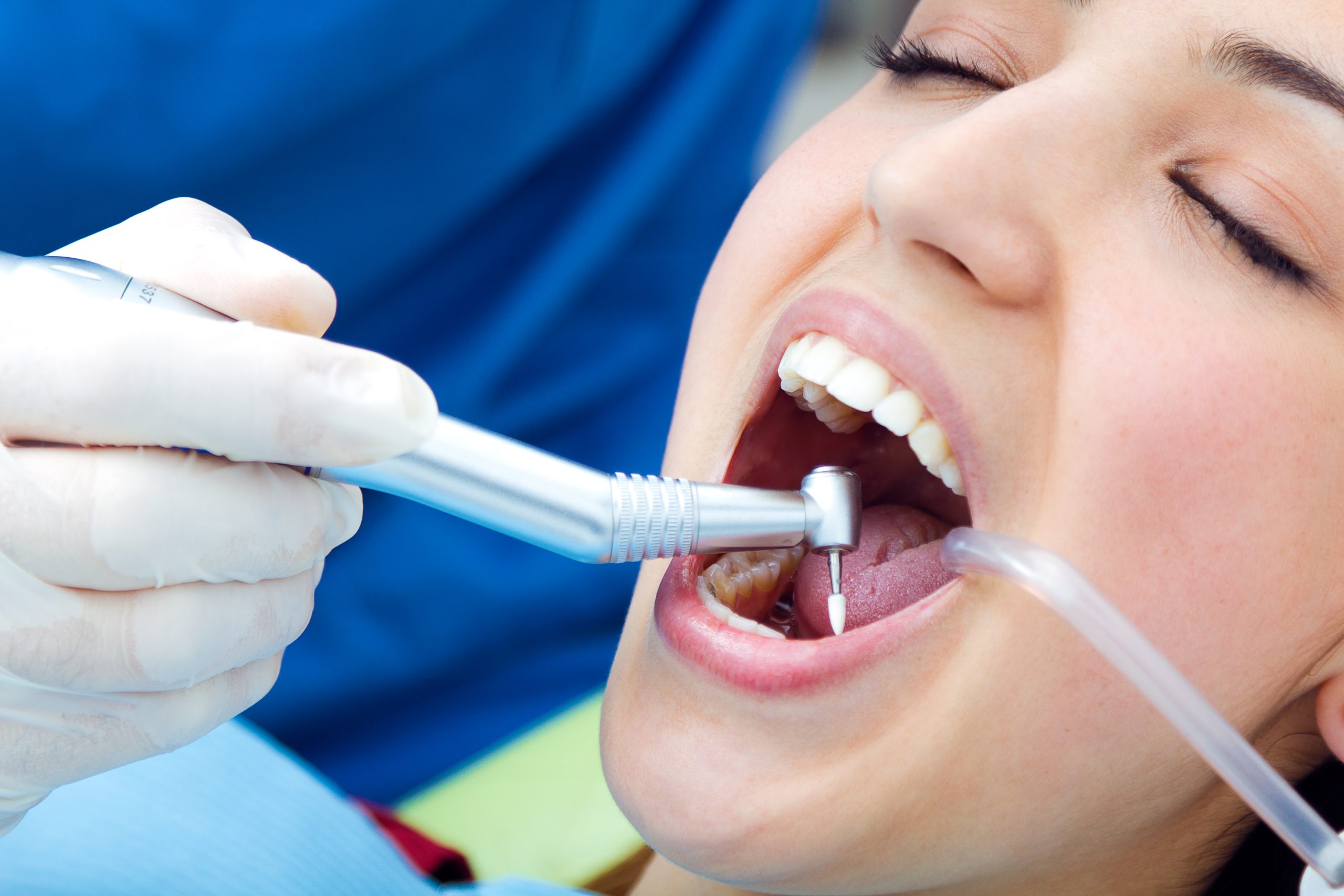 Dental scaling and polishing for optimal oral health