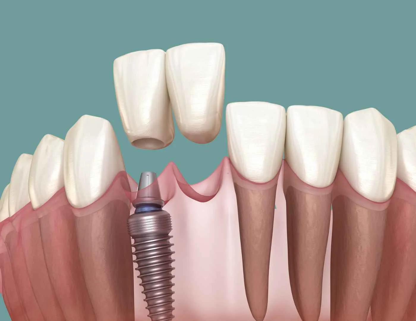 Permanent dental implant solutions