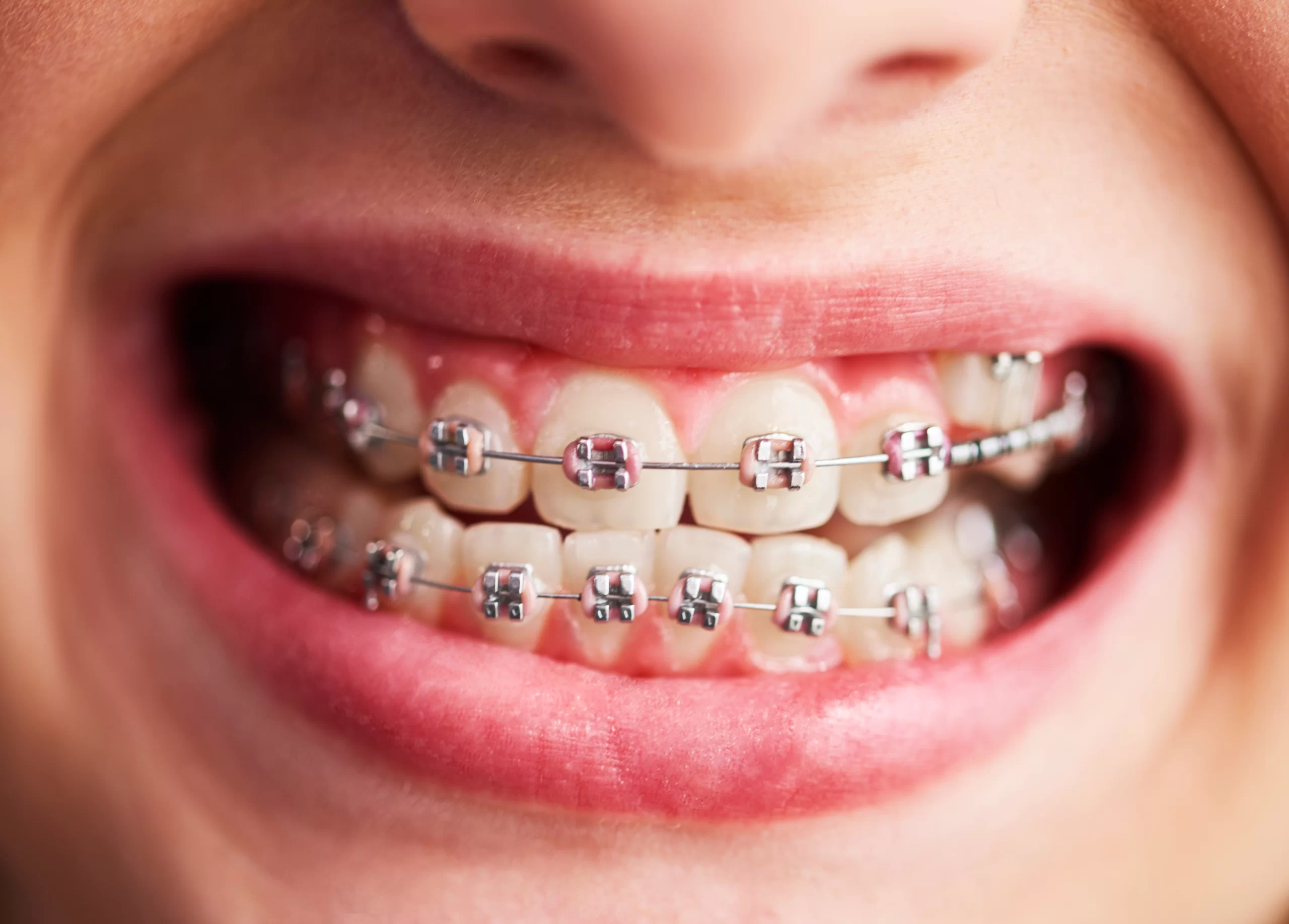 Orthodontic braces and clear aligners treatment